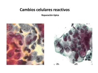 Cambios celulares reactivos
           Reparación típica
 