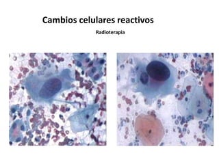 Cambios celulares reactivos
            Radioterapia
 