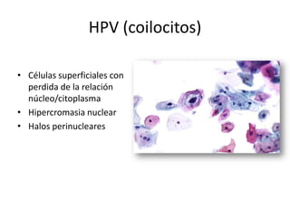 HPV (coilocitos)

• Células superficiales con
  perdida de la relación
  núcleo/citoplasma
• Hipercromasia nuclear
• Halos perinucleares
 