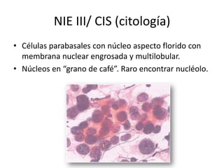 NIE III/ CIS (citología)
• Células parabasales con núcleo aspecto florido con
  membrana nuclear engrosada y multilobular.
• Núcleos en “grano de café”. Raro encontrar nucléolo.
 