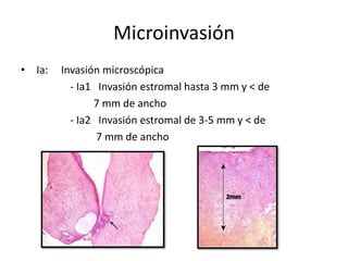 Microinvasión
• Ia:   Invasión microscópica
          - Ia1 Invasión estromal hasta 3 mm y < de
               7 mm de ancho
          - Ia2 Invasión estromal de 3-5 mm y < de
                7 mm de ancho
 