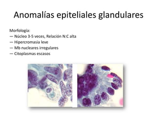Anomalías epiteliales glandulares
Morfología:
— Núcleo 3-5 veces, Relación N:C alta
— Hipercromasia leve
— Mb nucleares irregulares
— Citoplasmas escasos
 