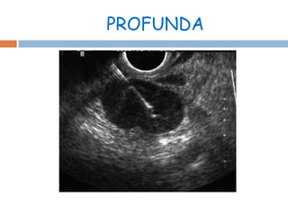 PROFUNDA 
