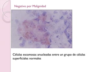 Negativo por Malignidad 
Células escamosas anucleadas entre un grupo de células 
superficiales normales 
 