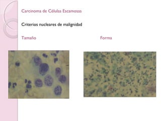 Carcinoma de Células Escamosas 
Criterios nucleares de malignidad 
Tamaño Forma 
 