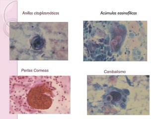 Anillos citoplasmáticos Acúmulos eosinofílicos 
Perlas Corneas Canibalismo 
 