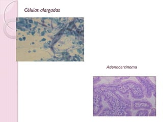 Células alargadas 
Adenocarcinoma 
 