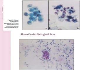 Alteración de células glandulares 
 