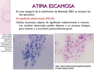AATTIIPPIIAA EESSCCAAMMOOSSAA 
En esta categoría de la clasificación de Bethesda 2001 se incluyen los 
dos apartados: 
De significado indeterminado (ASC-US) 
Células escamosas atípicas de significado indeterminado o incierto. 
Los cambios observados podían deberse a un proceso benigno, 
pero intenso, o a una lesión potencialmente grave. 
 