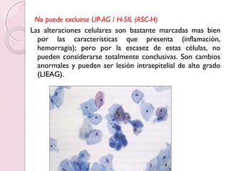No puede excluirse LIP-AG / H-SIL (ASC-H) 
Las alteraciones celulares son bastante marcadas mas bien 
por las características que presenta (inflamación, 
hemorragia); pero por la escasez de estas células, no 
pueden considerarse totalmente conclusivas. Son cambios 
anormales y pueden ser lesión intraepitelial de alto grado 
(LIEAG). 
 