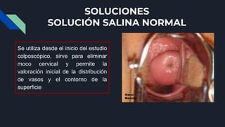 SOLUCIONES
SOLUCIÓN SALINA NORMAL
Se utiliza desde el inicio del estudio
colposcópico, sirve para eliminar
moco cervical y...