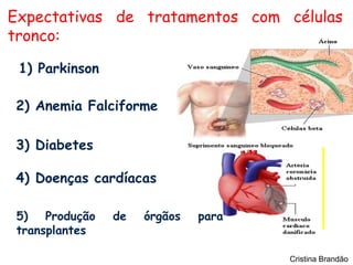 Expectativas de tratamentos com células
tronco:

 1) Parkinson

2) Anemia Falciforme

3) Diabetes

4) Doenças cardíacas

 5) Produção    de   órgãos   para
 transplantes

                                     Cristina Brandão
 