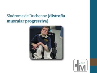 Síndromede Duchenne(distrofia
muscularprogressiva)
 