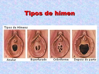 Tipos de hímen
 