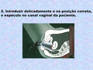 2. Introduzir delicadamente e na posição correta,
o espéculo no canal vaginal da paciente.
 