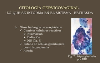 CITOLOGÍA CERVICOVAGINAL
LO QUE SE INFORMA EN EL SISTEMA BETHESDA
b. Otros hallazgos no neoplásicos
 Cambios celulares reactivos
 Inflamación
 Radiación
 DIU (fig. 7)
 Estado de células glandulares
post-histerectomía
 Atrofia
Fig. 7. Atipia glandular
por DIU
 