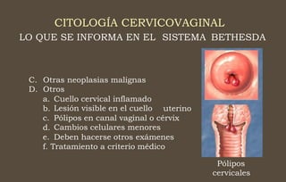 CITOLOGÍA CERVICOVAGINAL
LO QUE SE INFORMA EN EL SISTEMA BETHESDA
C.
D.
Otras neoplasias malignas
Otros
a.
b.
c.
d.
e.
Cuello cervical inflamado
Lesión visible en el cuello uterino
Pólipos en canal vaginal o cérvix
Cambios celulares menores
Deben hacerse otros exámenes
f. Tratamiento a criterio médico
Pólipos
cervicales
 