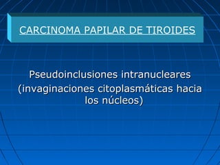Pseudoinclusiones intranuclearesPseudoinclusiones intranucleares
(invaginaciones citoplasmáticas hacia(invaginaciones citoplasmáticas hacia
los núcleos)los núcleos)
CARCINOMA PAPILAR DE TIROIDES
 