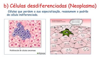b) Células desdiferenciadas (Neoplasma)
  Células que perdem a sua especialização, reassumem o padrão
 de célula indiferenciada.
 