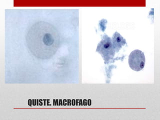 QUISTE. MACROFAGO
 