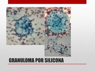 GRANULOMA POR SILICONA
 