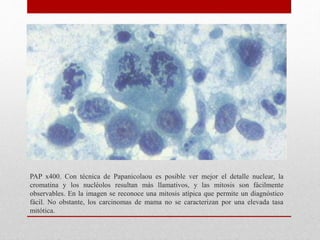 PAP x400. Con técnica de Papanicolaou es posible ver mejor el detalle nuclear, la
cromatina y los nucléolos resultan más llamativos, y las mitosis son fácilmente
observables. En la imagen se reconoce una mitosis atípica que permite un diagnóstico
fácil. No obstante, los carcinomas de mama no se caracterizan por una elevada tasa
mitótica.
 