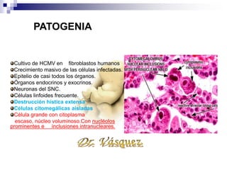 PATOLOGIA
Cultivo de HCMV en fibroblastos humanos
Crecimiento masivo de las células infectadas.
Epitelio de casi todos los órganos.
Órganos endocrinos y exocrinos.
Neuronas del SNC.
Células linfoides frecuente.
Destrucción hística extensa
Células citomegálicas aisladas
Célula grande con citoplasma
escaso, núcleo voluminoso.Con nucléolos
prominentes e inclusiones intranucleares.
PATOGENIA
 