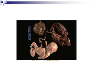 3. Infección prenatal.
Infección intrauterina.
Infección congénita en un 40 %
Presentan manifestaciones clínicas 5 a 10 %
Desarrollan tardíamente alteraciones en psicomotor o
sensoriales.
Afección primera mitad del embarazo
En USA se calcula que nacen 50 000 afectados cada
año.
 