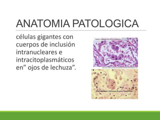 ANATOMIA PATOLOGICA
células gigantes con
cuerpos de inclusión
intranucleares e
intracitoplasmáticos
en” ojos de lechuza”.
 
