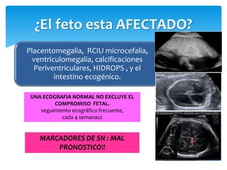 Placentomegalia, RCIU microcefalia,
ventriculomegalia, calcificaciones
Periventriculares, HIDROPS , y el
intestino ecogénico.
¿El feto esta AFECTADO?
UNA ECOGRAFIA NORMAL NO EXCLUYE EL
COMPROMISO FETAL.
seguimiento ecográfico frecuente,
cada 4 semanas2
MARCADORES DE SN : MAL
PRONOSTICO!!
 