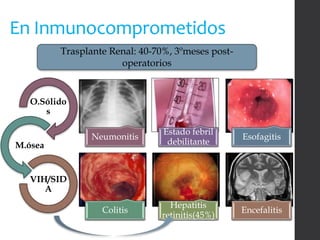En Inmunocomprometidos
O.Sólido
s
M.ósea
VIH/SID
A
Trasplante Renal: 40-70%, 3ºmeses post-
operatorios
Neumonitis
Estado febril
debilitante
Esofagitis
Colitis
Hepatitis
retinitis(45%)
Encefalitis
 