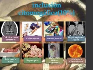 inclusión
citomegálica(10%)
Calcificaciones
cerebrales
Convulsiones Sordera, retardo
Hepatoesplenom
egalia
Bajo peso al
nacer
Plaquetopenia
Daño SNC:
Hidro-
Microcefalia
+/- Miopia y
Coriorretinitis
 