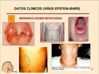 DATOS CLÍNICOS (VIRUS EPSTEIN-BARR)  MONONUCLEOSIS INFECCIOSA : 1 