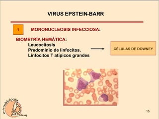 VIRUS EPSTEIN-BARR  MONONUCLEOSIS INFECCIOSA : 1 BIOMETRÍA HEMÁTICA :  Leucocitosis  Predominio de linfocitos.  Linfocitos T atípicos grandes CÉLULAS DE DOWNEY 
