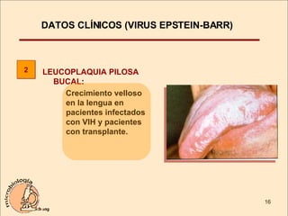 LEUCOPLAQUIA PILOSA BUCAL :  Crecimiento velloso en la lengua en pacientes infectados con VIH y pacientes con transplante. 2 DATOS CLÍNICOS (VIRUS EPSTEIN-BARR)  