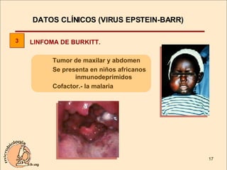 LINFOMA DE BURKITT. Tumor de maxilar y abdomen  Se presenta en niños africanos  inmunodeprimidos Cofactor.- la malaria 3 DATOS CLÍNICOS (VIRUS EPSTEIN-BARR)  