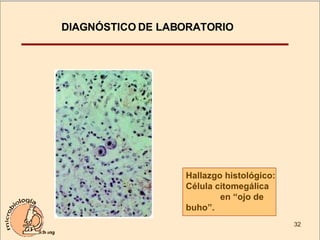 DIAGNÓSTICO DE LABORATORIO Hallazgo histológico:  Célula citomegálica  en “ojo de buho”.  