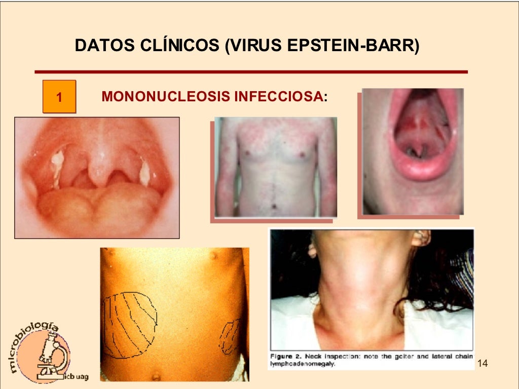 Citomegalovirus Y Epstein Barr