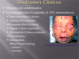 Mayoría son asintomatico Cytomegalovirus Congenito (1-10% sintomaticos) Parto prematuro o aborto Ictericia (Piel amarilla) Petequías (Rash al nacer) Higado y bazo engrosado Microsefalia (Cabeza pequeña) Convulciones Deformidad:  Hepatrosplenomelagy  Jaundice Thrombo http://aapredbook.aappublications.org/week/iotw031207.dtl 