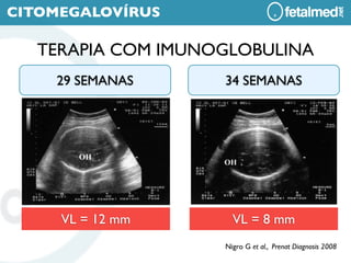 CITOMEGALOVÍRUS

  TERAPIA COM IMUNOGLOBULINA
    29 SEMANAS     34 SEMANAS




     VL = 12 mm      VL = 8 mm
                   Nigro G et al., Prenat Diagnosis 2008
 