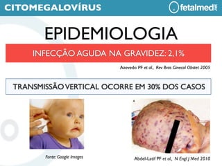 CITOMEGALOVÍRUS


        EPIDEMIOLOGIA
     INFECÇÃO AGUDA NA GRAVIDEZ: 2,1%
                               Azevedo PF et al., Rev Bras Ginecol Obstet 2005



 TRANSMISSÃO VERTICAL OCORRE EM 30% DOS CASOS




        Fonte: Google Images          Abdel-Latif PF et al., N Engl J Med 2010
 