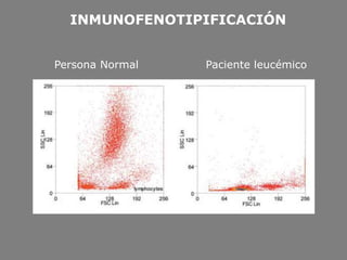 INMUNOFENOTIPIFICACIÓN
Persona Normal Paciente leucémico
 