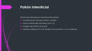 Patrón Intersticial
Afectación del espacio intersticial del pulmón
 Condensación reticular, lineal o nodular.
 Líneas intersticiales de Kerley (A,B o C)
 Imagen de pulmón en panal.
 Nódulos miliares (2-5 mm) tienden a la sumaciòn, no a coalescer.
 