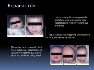 Reparación

                                            •    son la reparación por capas de la
                                                piel el músculo y la mucosa para
                                                restablecer la función y la longitud
                                                simétrica


                                         Reparación de labio leporino unilateral con
                                         rotación-avance de Millard



   El objetivo de la reparación de la
    fisura palatina es establecer una
    válvula competente que pueda
    aislar las cavidades oral y nasal




                                                                                       29
 