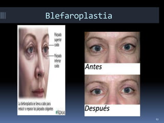 Blefaroplastia




                 67
 