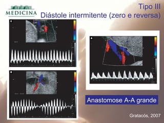 Tipo III
Diástole intermitente (zero e reversa)
Anastomose A-A grande
Gratacós, 2007
 