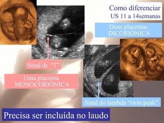 Duas placentas
DICORIÔNICA
Sinal do “T”
Uma placenta
MONOCORIÔNICA
Precisa ser incluída no laudo
Como diferenciar
US 11 a 14semanas
Sinal do lambda “twin peak”
 