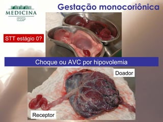 Doador
Receptor
Gestação monocoriônica
Choque ou AVC por hipovolemia
STT estágio 0?STT estágio 0?
 