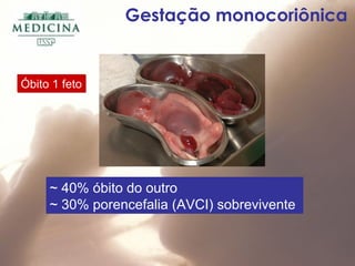 Gestação monocoriônica
~ 40% óbito do outro
~ 30% porencefalia (AVCI) sobrevivente
Óbito 1 fetoÓbito 1 feto
 