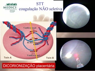 STT
coagulação NÃO seletiva
DICORIONIZAÇÃO placentáriaDICORIONIZAÇÃO placentária
 